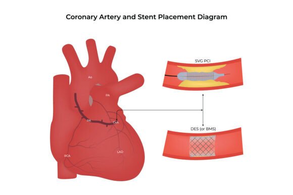 Coronary Artery and Stent Placement
