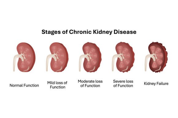 Stages of Chronic Kidney Disease Illustr